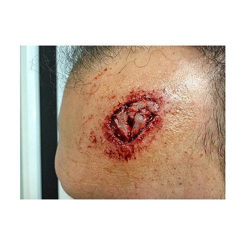Prosthetic Mould - Fracture by Stuart Bray