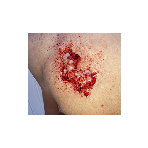 Prosthetic Mould Infected